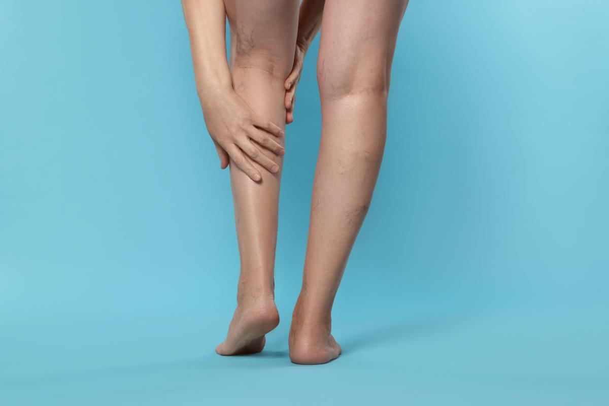 A person stands against a blue background, one hand resting on the left calf, revealing bare legs with visible varicose veins.
